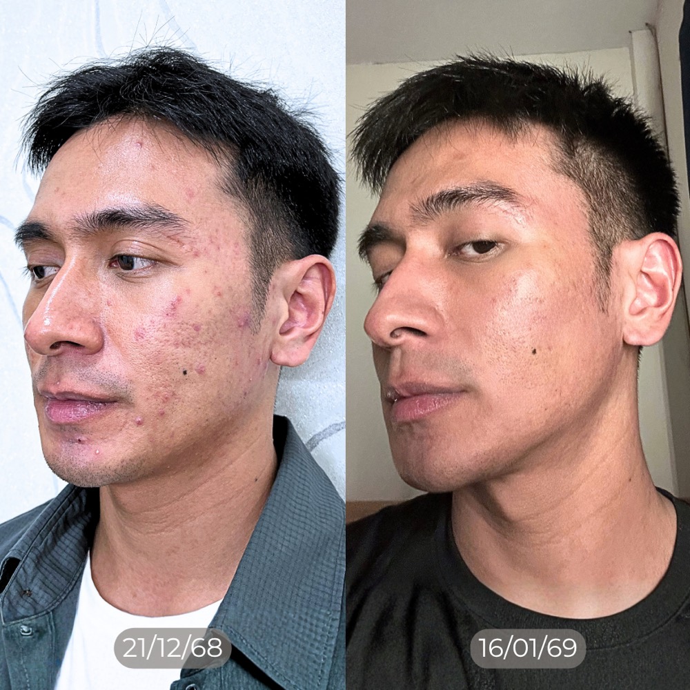 ภาพติดตามการรักษาผู้ที่ยังมีสิวอักเสบร่วมกับแผลเป็น เปรียบเทียบ 21 ธันวาคม 2568 และ 16 มกราคม 2569