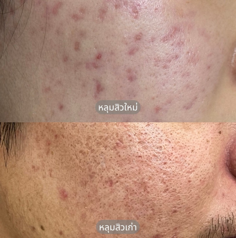 ภาพเปรียบเทียบหลุมสิวใหม่กับหลุมสิวเก่าจากผู้เข้ารับบริการจริง